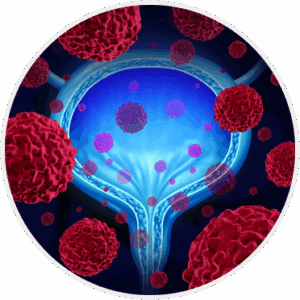 Bladder Cancer