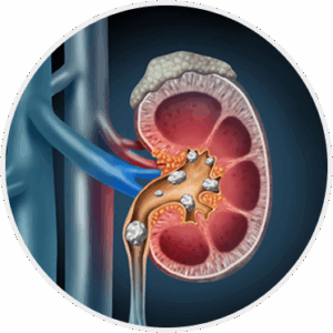 Kidney Stone Removal