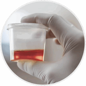 Blood in Urine