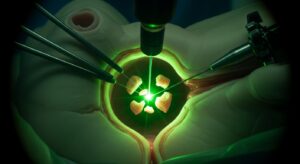 Holmium Laser Enucleation of the Prostate (HoLEP)