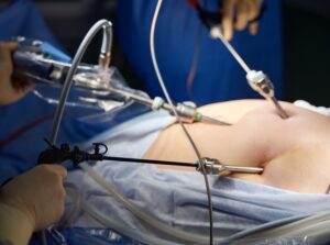 Laparoscopic Ureterolithotomy and Pyelolithotomy