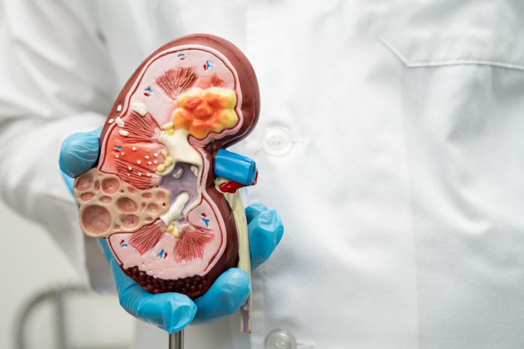 Kidney Cyst in Singapore