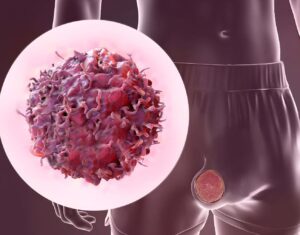 Testicular cancer