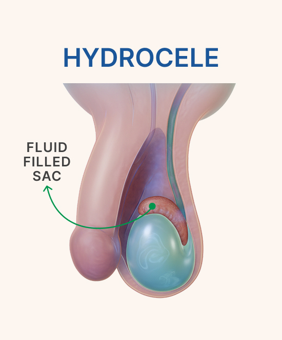 Hydrocele (1)