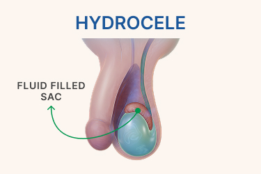 Hydrocele: Understanding Causes, Symptoms, and Treatment Options