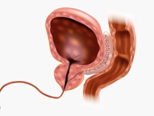 Urethrotomy
