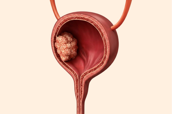 Bladder Cancer Treatment in Singapore