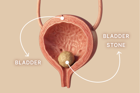 Bladder Stone Treatment in Singapore