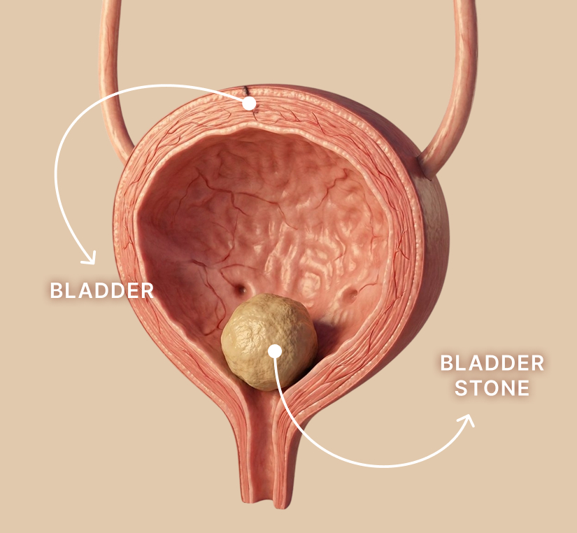 Illustration of a bladder with a bladder stone inside, labeled to show the bladder and the bladder stone.