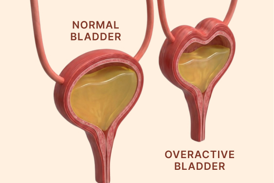 Overactive Bladder Treatment in Singapore