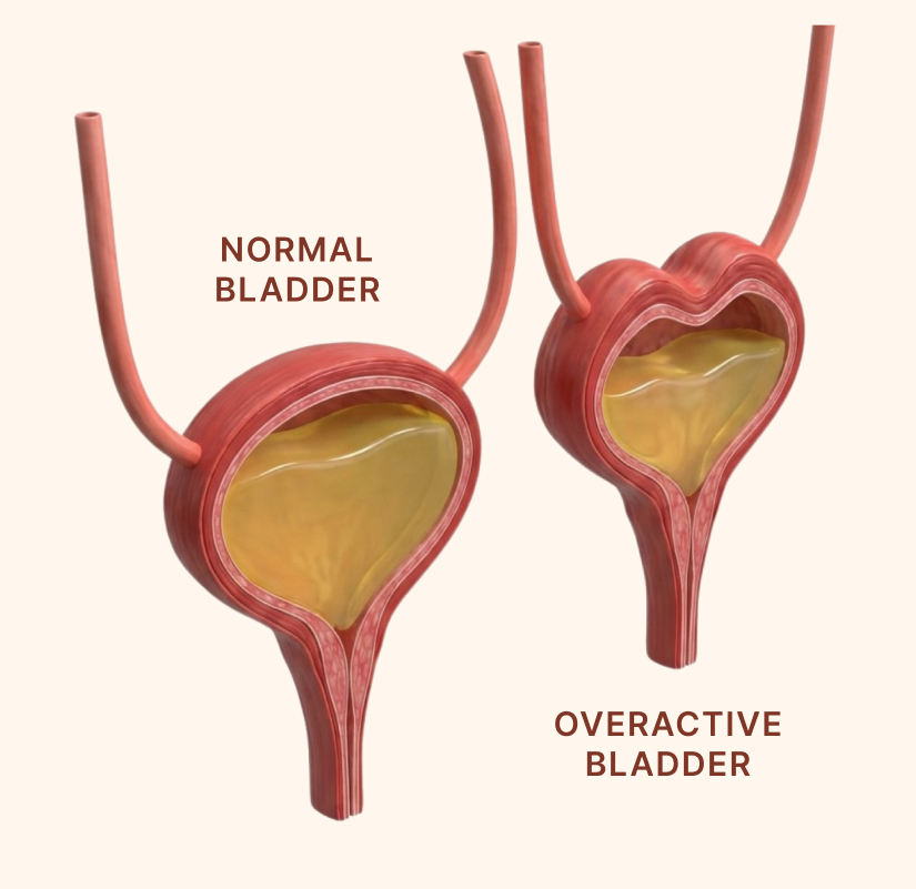 Illustration comparing a normal bladder to an overactive bladder.