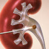 PCNL — Percutaneous Nephrolithotomy