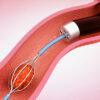 RIRS — Retrograde Intrarenal Surgery