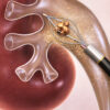 Ureteroscopy (URS)