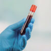 Prostate Cancer-Diagnosis-PSA Blood Test