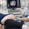 Prostate Cancer-Diagnosis-Prostate Biopsy